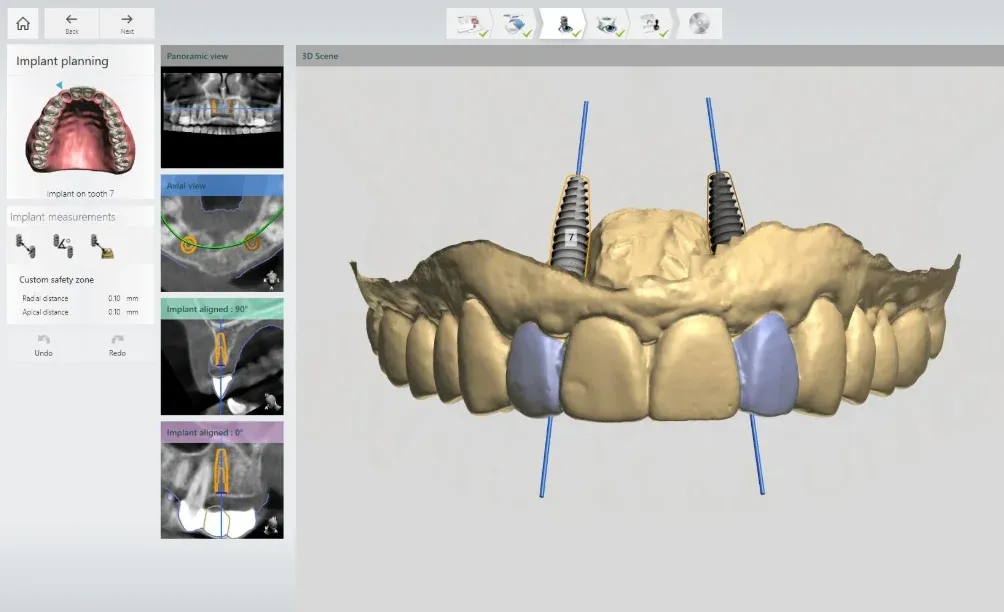 A CBCT-based implant plan with virtual implants placed in a 3D reconstruction.