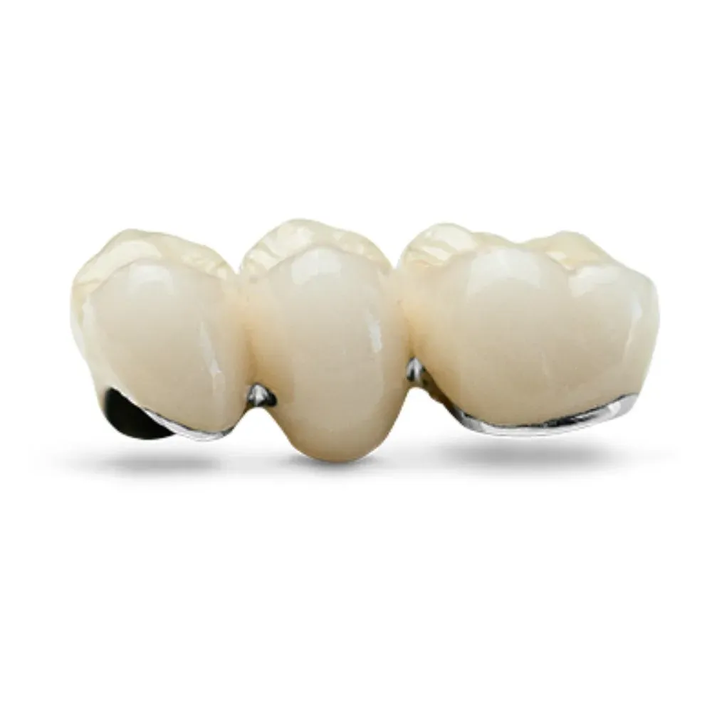 PFM bridge, cast framework layered with porcelain