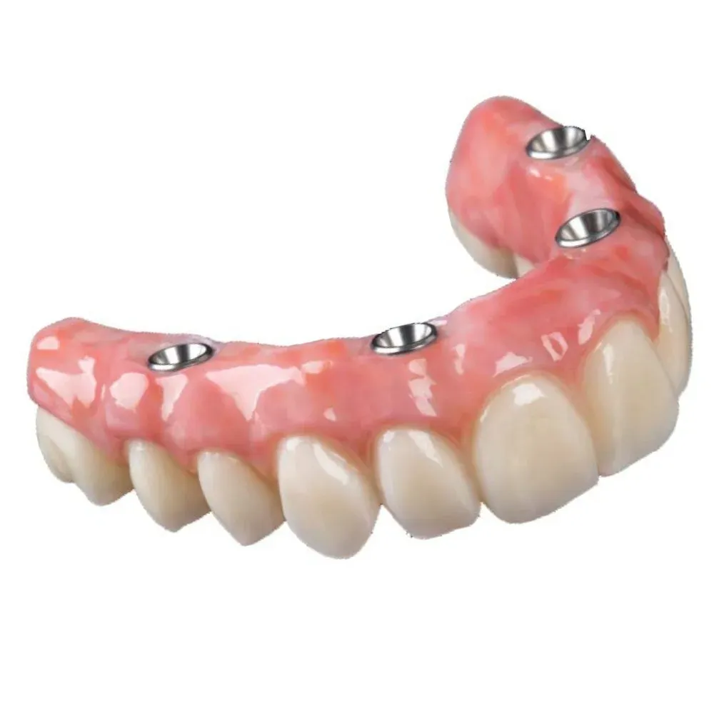 Implant overdenture seated on locator attachments