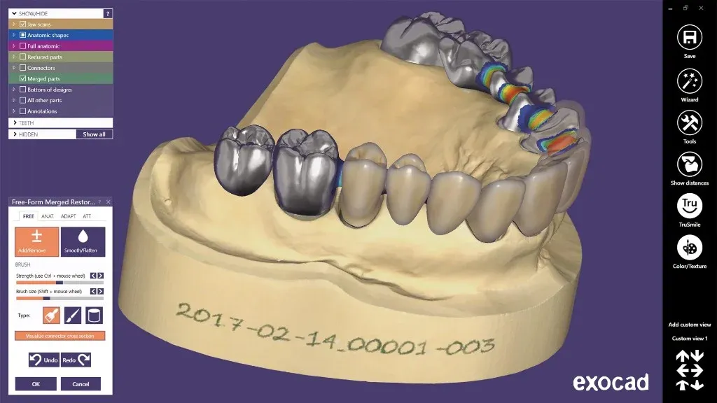 Digital dentistry workflow with scan and CAD design on screen