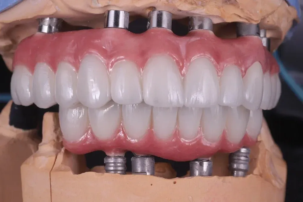 Fixed full-arch hybrid prosthesis seated on a model