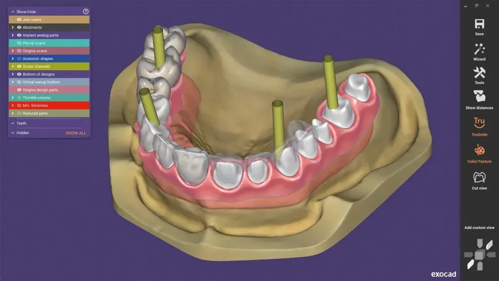 Full-arch plan on screen with the transition line marked against a smile photograph