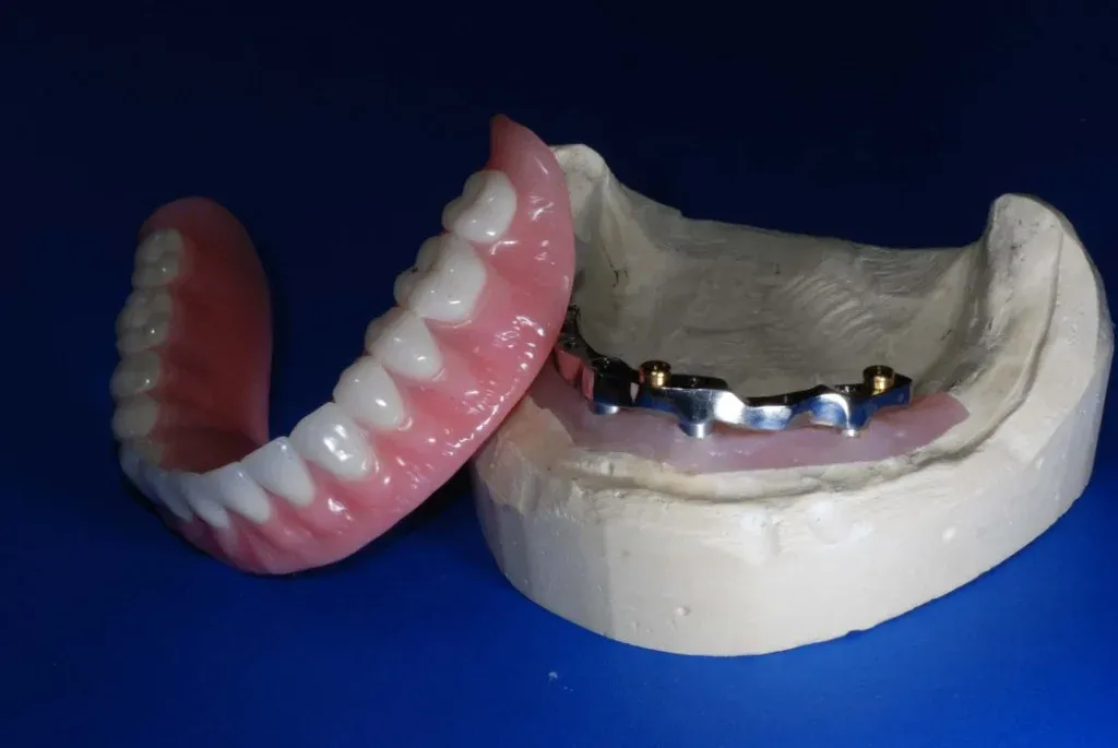Implant overdenture and a fixed full-arch prosthesis side by side