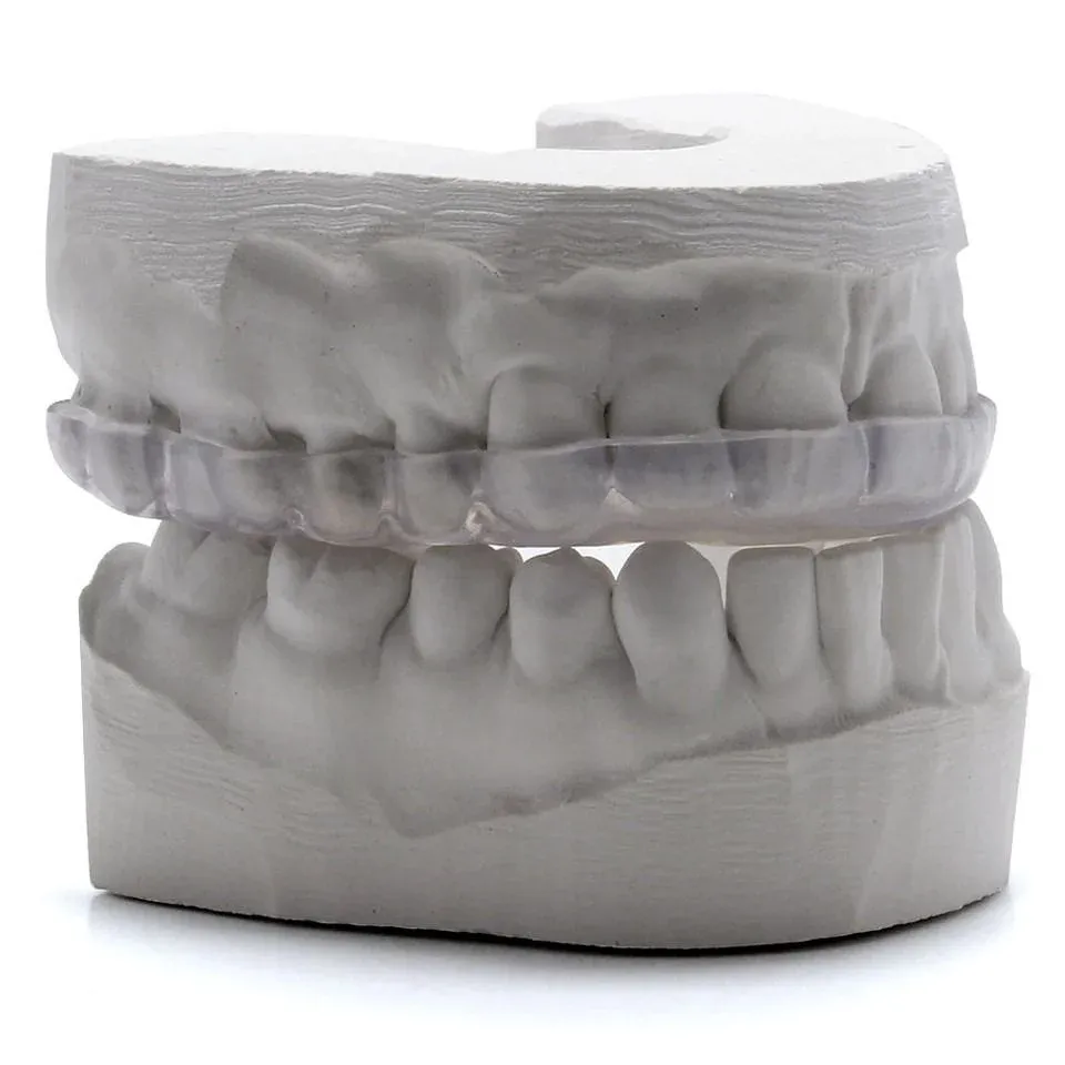 Printed resilient KeySplint Soft appliance seated on the master model