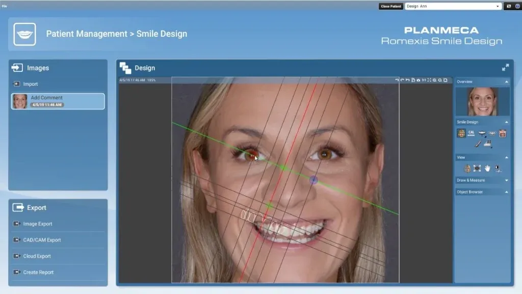 Digital smile design proof displayed on a lab screen