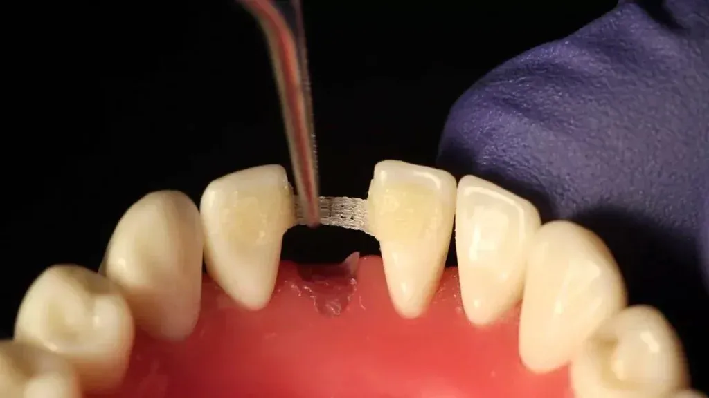 A technician refining the intaglio of a resin-bonded retainer wing