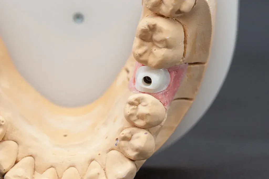 Finished custom abutment on a titanium base seated on an implant analog