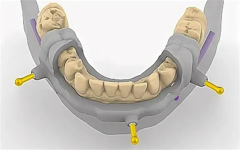 Surgical guide design derived from the approved implant plan, sleeve positions in place on the model