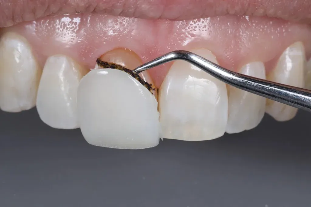Try-in mockup seated over unprepped anterior teeth, patient reviewing in a mirror