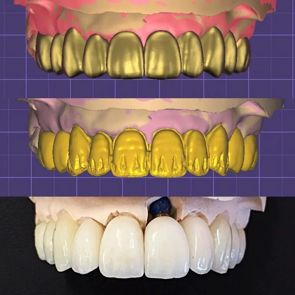 Incisal edge cross-section in the design software showing thickness against the opposing arch