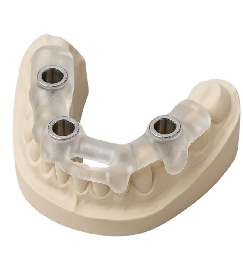 Clear printed surgical guide with metal guide sleeves, seated on a stone working model of the arch.