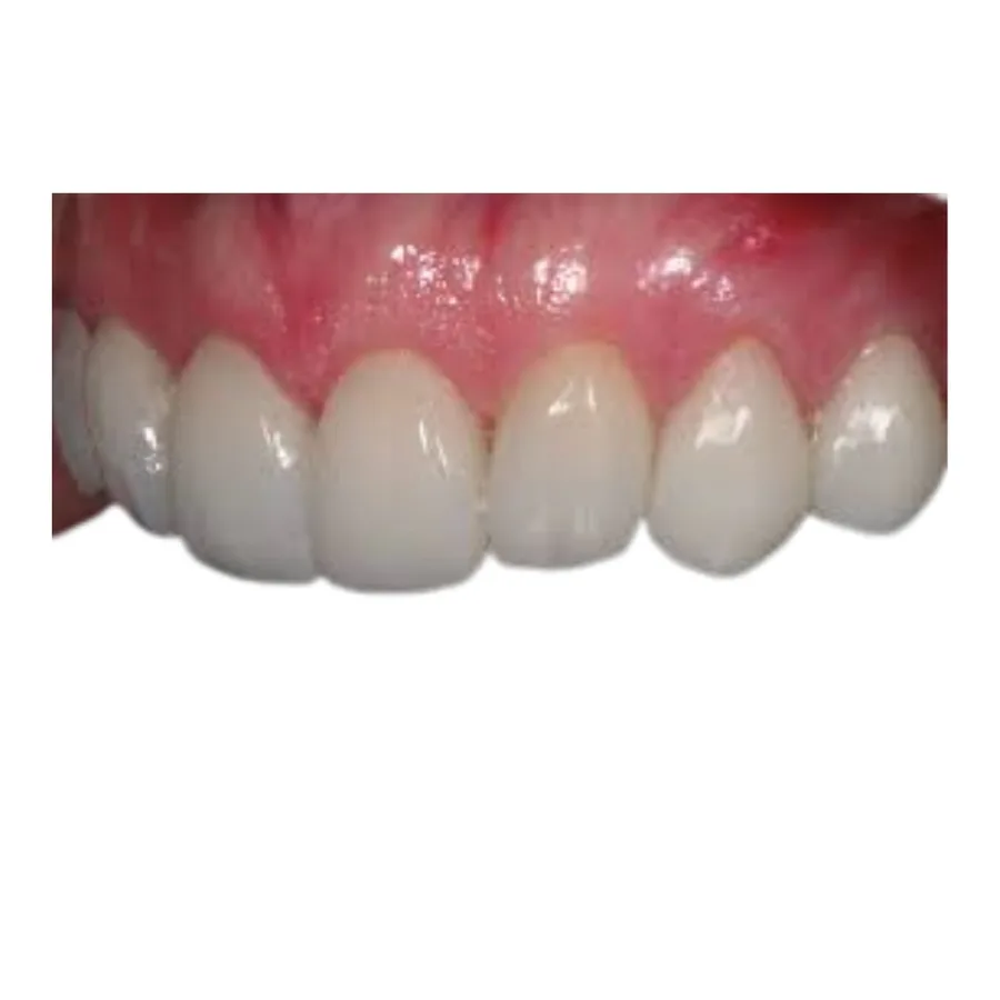 Anterior restorations designed to midline and tooth proportion