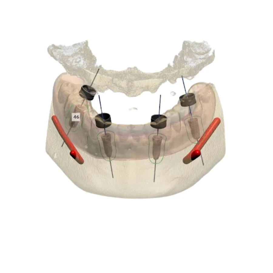 Implant case planned prosthetically from the final restoration on screen