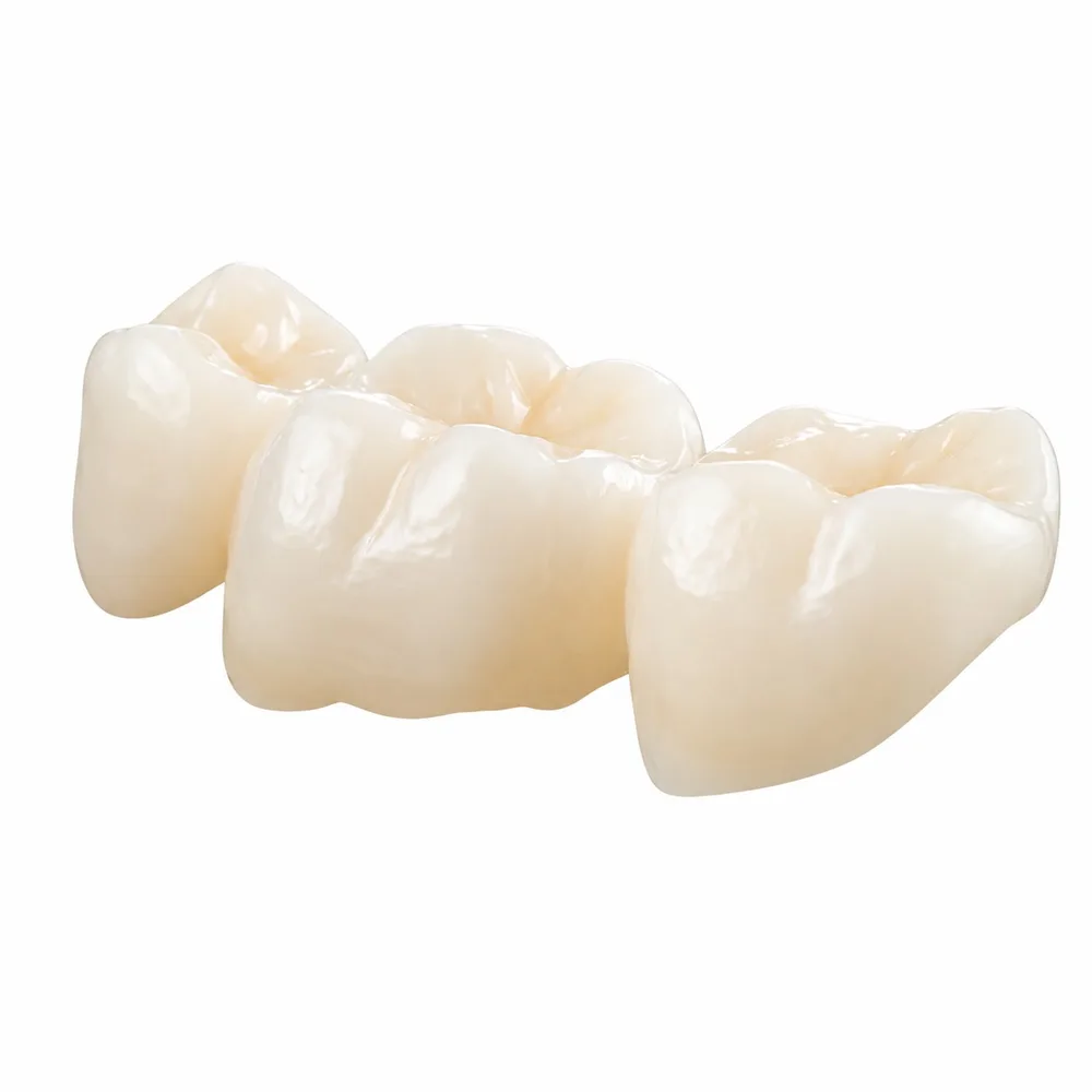Cantilever dental bridge