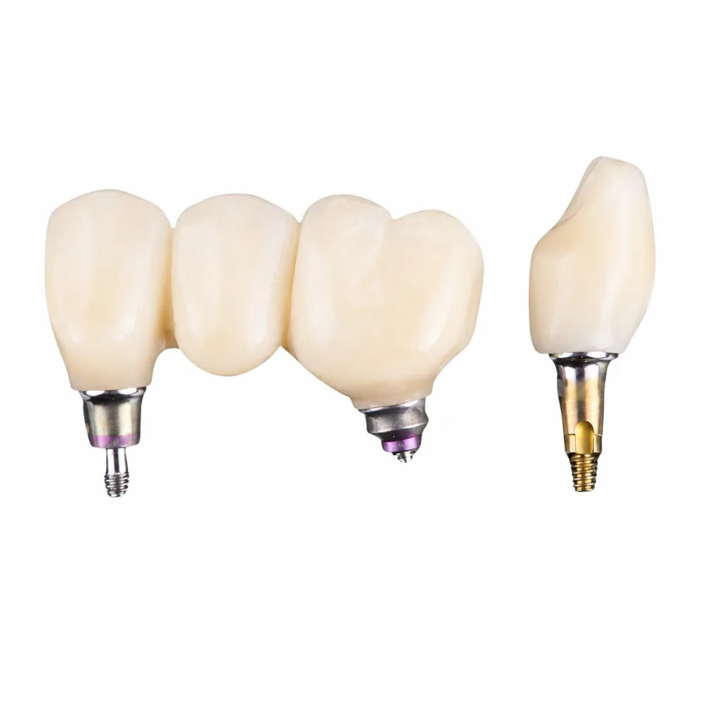 Implant-supported bridge framework