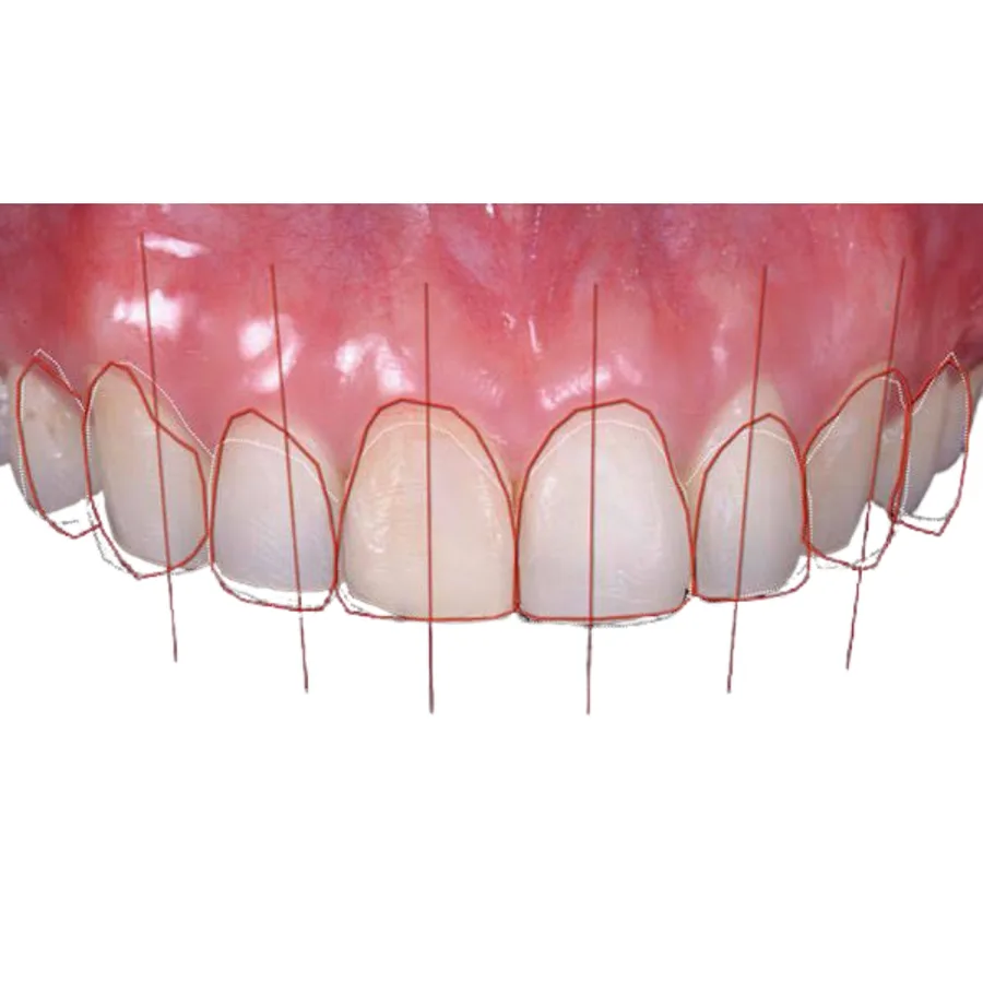 Digital smile design overlaid on a patient facial photo