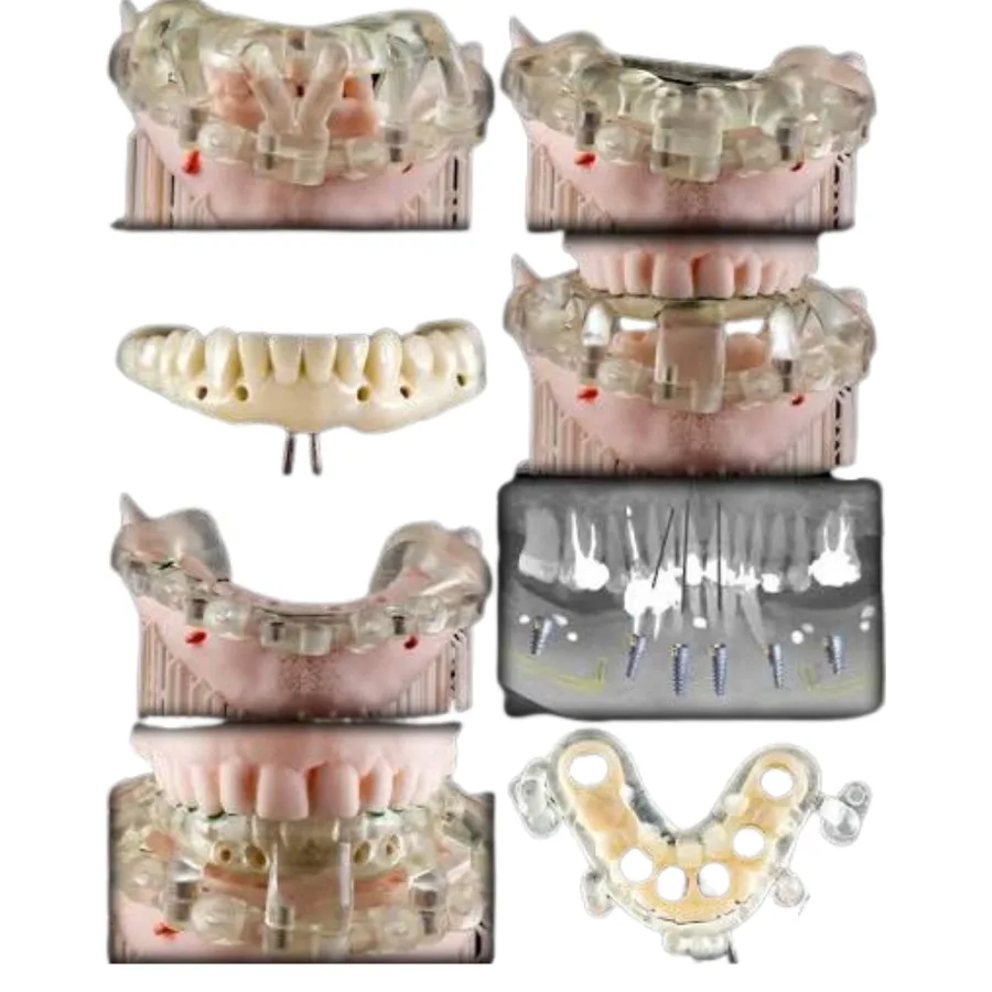 Full-arch bone reduction guide establishing the planned osseous plane
