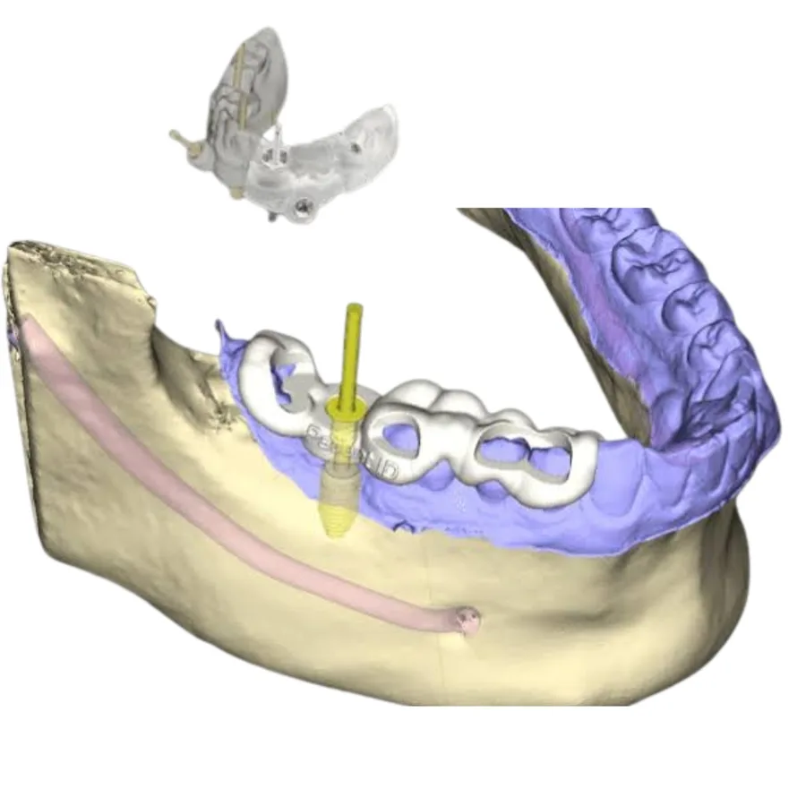 Printed surgical guide with metal sleeves seated on a model